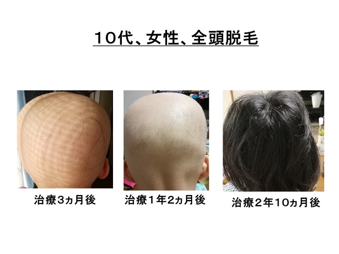円形脱毛症　病院